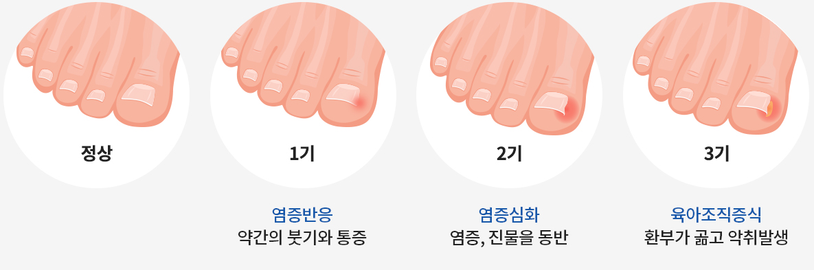 손발톱 무좀