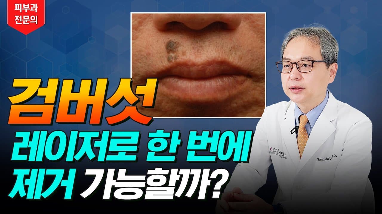 老人性イボはレーザーで一度に除去できる？シミ取りの方法