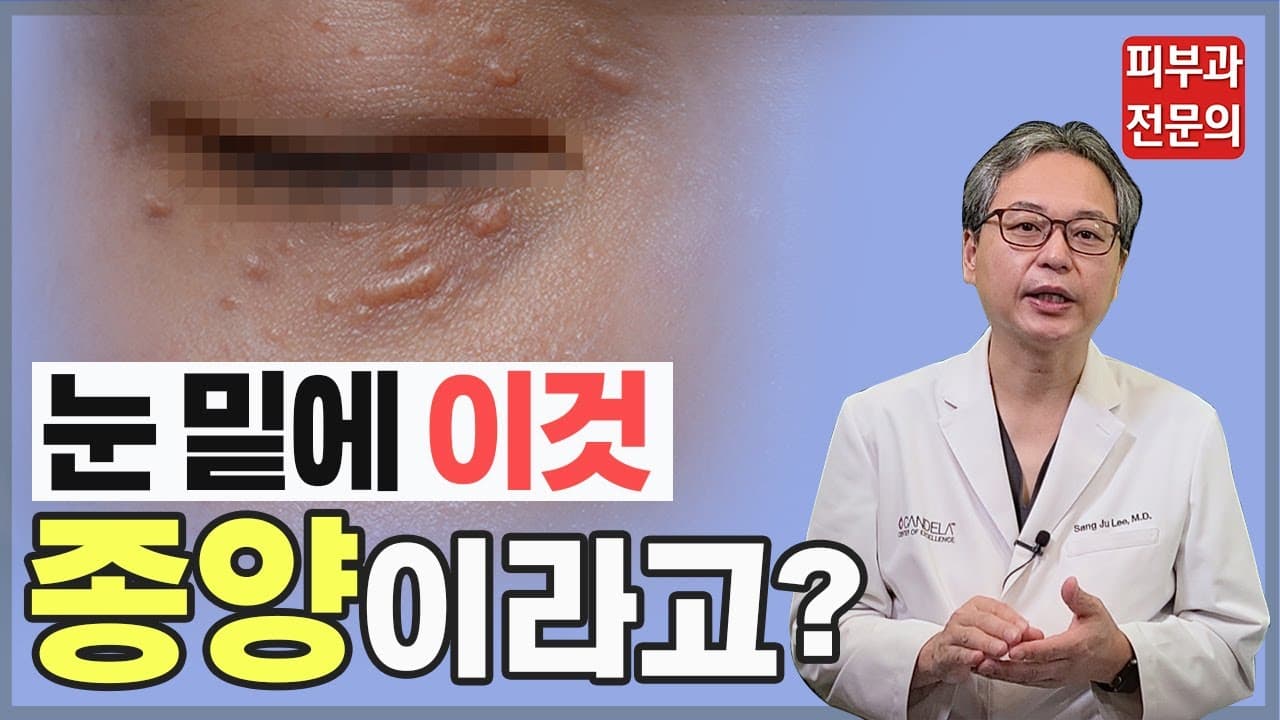 这竟然是肿瘤？？？告诉你治疗方法（汗管瘤、眼下汗管瘤）