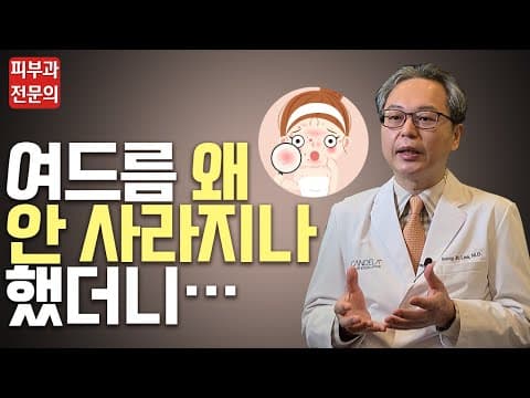 [여드름재발, 피부여드름] 여드름 왜 안 사라지나 했더니… 여드름의 원인은?
