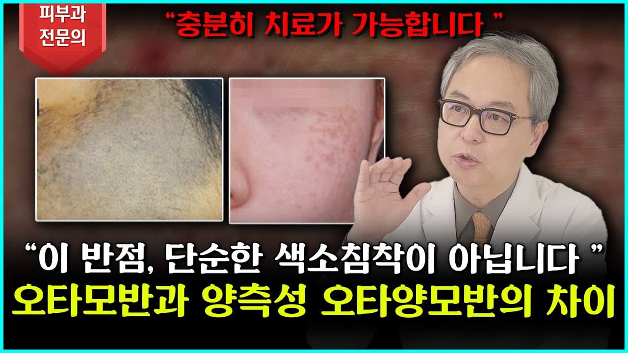 听说过太田痣吗？容易与之混淆的双侧性太田痣样色素斑，今天为您准确讲解