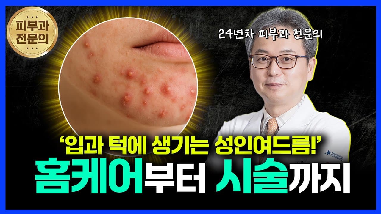 嘴周下巴痘痘从居家护理到皮肤科治疗全攻略