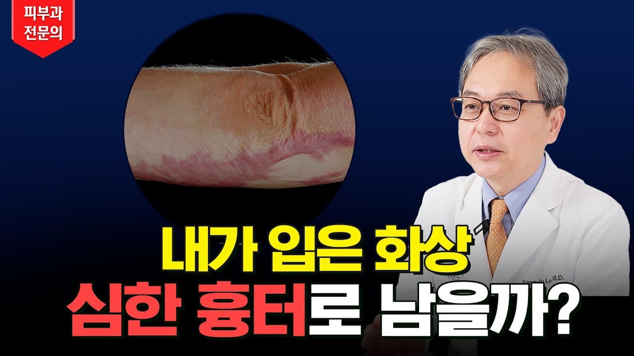 やけどをしたら必見 やけど跡が残りやすいケースを解説