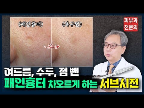 Atrophic Scar Subcision Everything When Laser Does Not Work