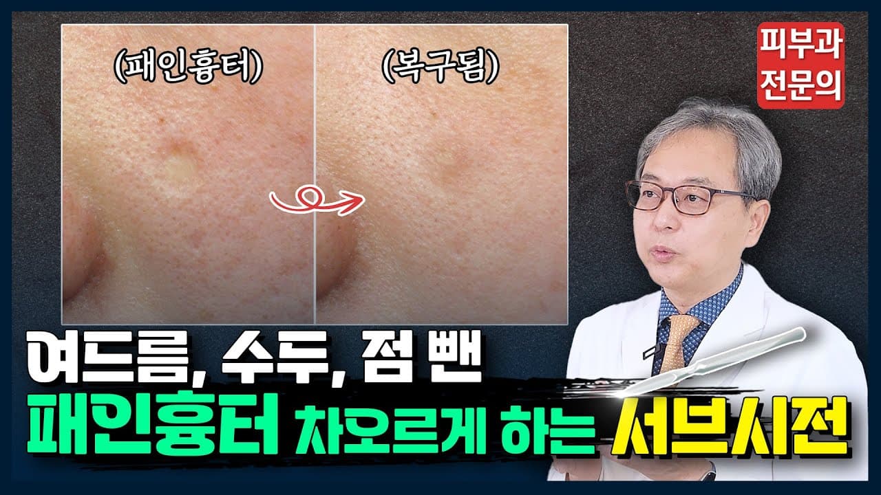 Atrophic Scar Subcision Everything When Laser Does Not Work