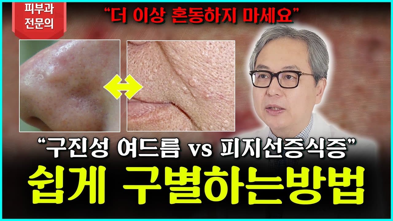 丘疹性痘疤vs皮脂腺增生！轻松区分两者的方法
