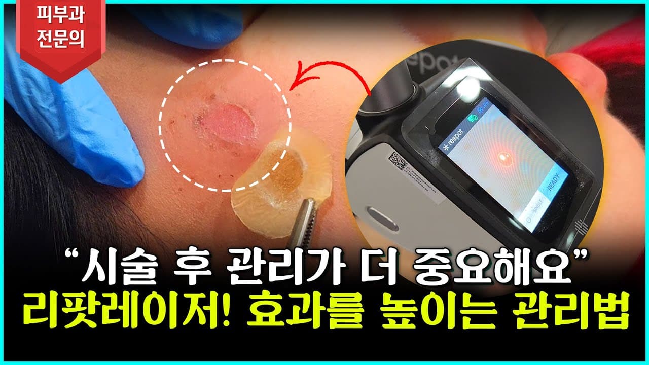 リパットレーザー施術だけで終わり？本当の効果は「これ」次第です