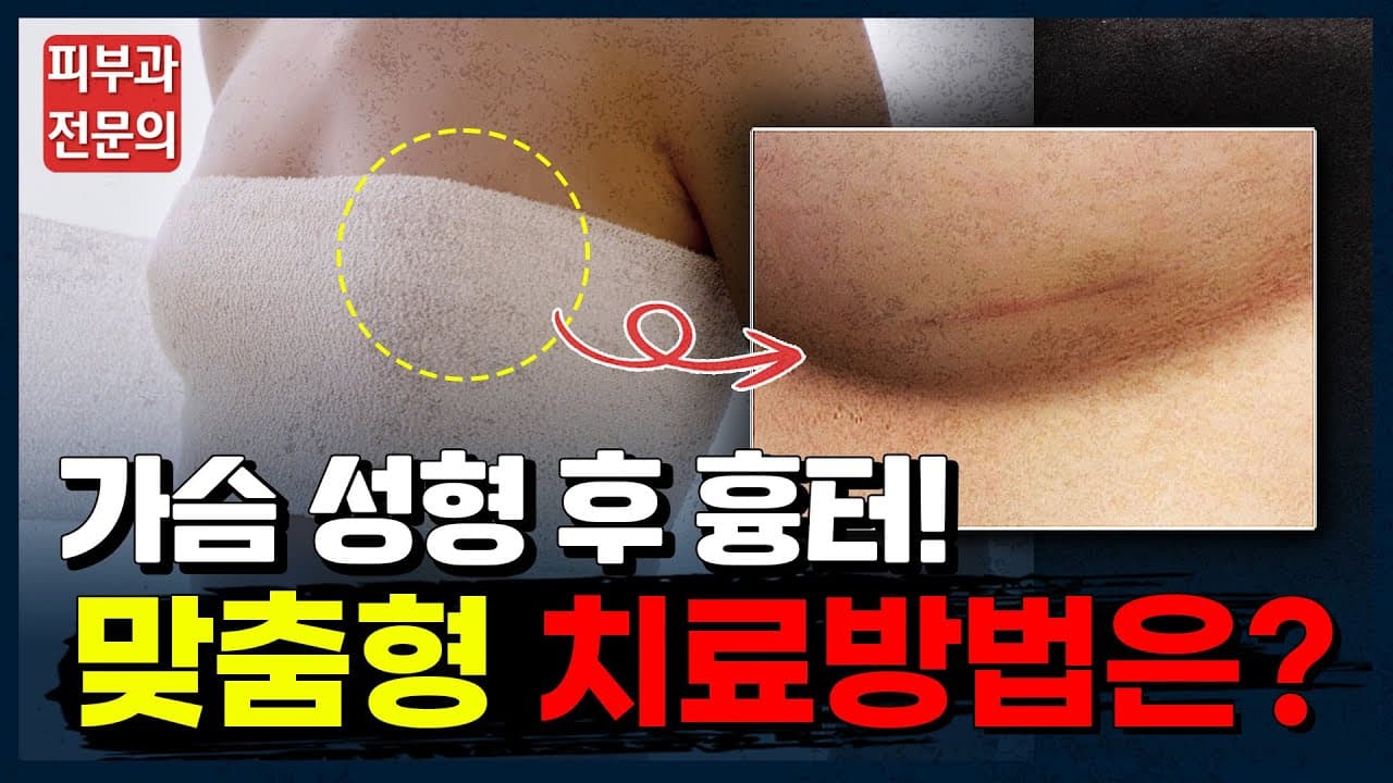 Breast Augmentation Scar Removal Without Additional Surgery