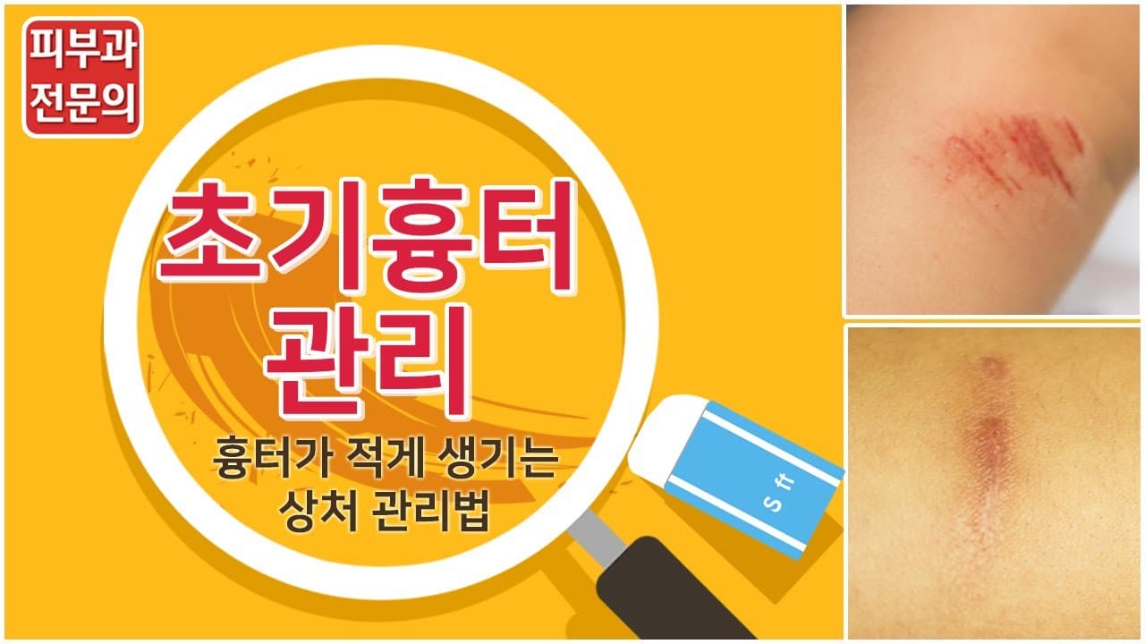 흉터를 적게 남기는 상처 관리법(초기 붉은 흉터관리)