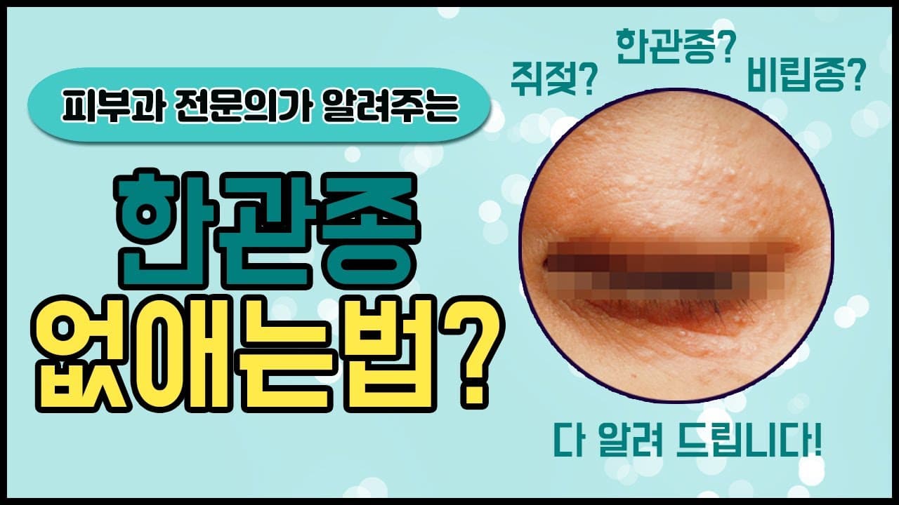 한관종 원인과 제거방법 공개 (feat. 비립종,편평사마귀,쥐젖)