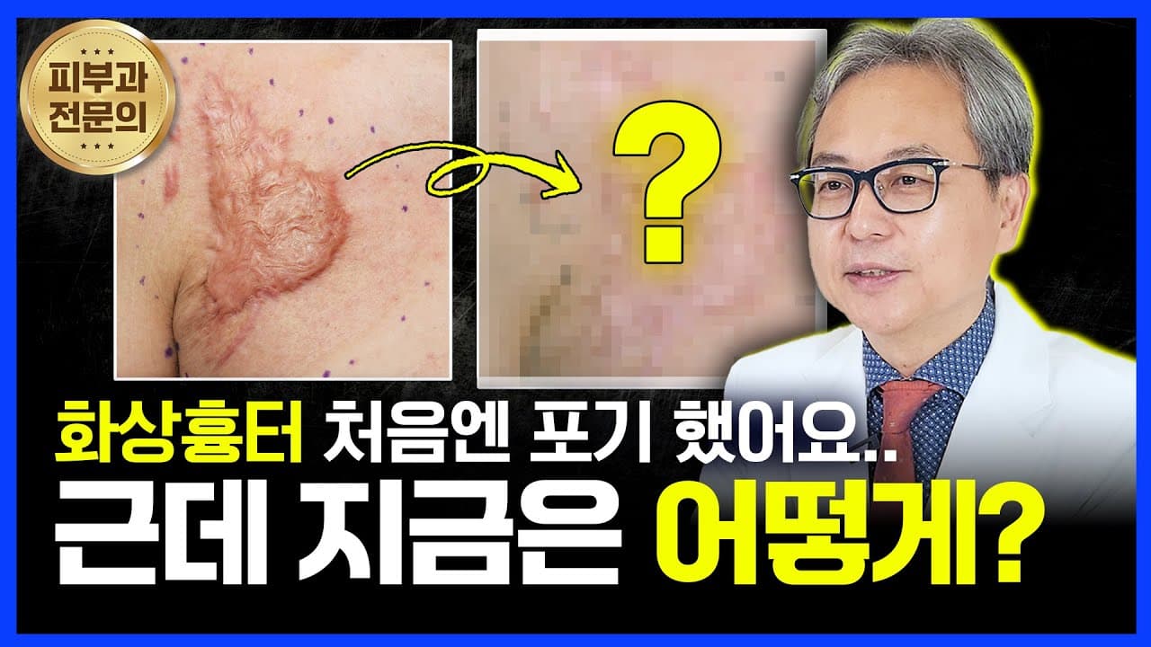 화상 흉터? 치료는 못 한다고요? 지금은 어떨까요?