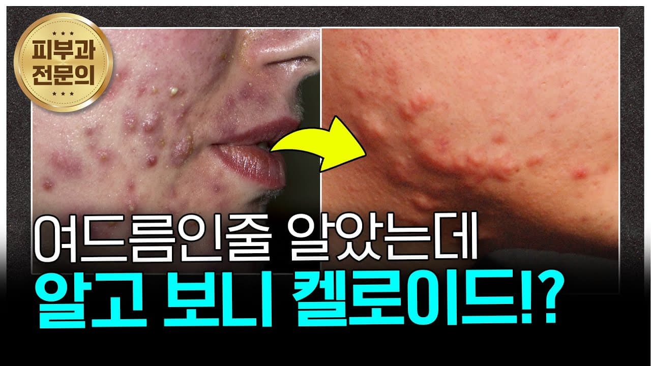 여드름인 줄 알았는데… 알고 보니 ‘켈로이드’였습니다