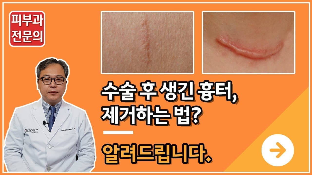 수술후 생긴 수술흉터, 제거 방법은?