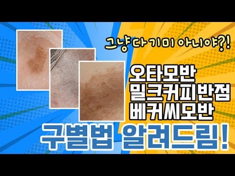 这不是黄褐斑 - 太田痣、咖啡牛奶斑、贝克痣的区分方法！