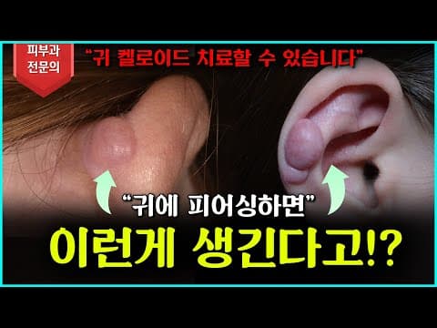 [귀켈로이드] 더 커지기 전에 치료하세요!🚨🚨 효과적인 치료법 공개!