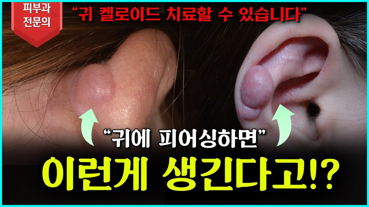 [귀켈로이드] 더 커지기 전에 치료하세요!🚨🚨 효과적인 치료법 공개!