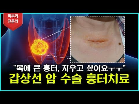 [갑상선암수술흉터] 그대로 두지 마세요! 요즘은 이렇게 치료합니다!
