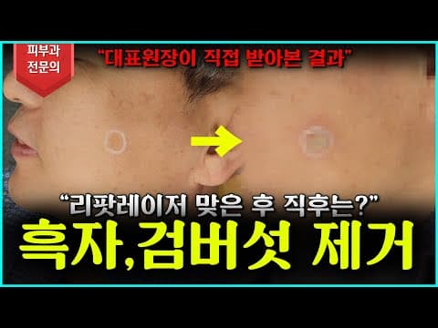 [흑자,검버섯] 피부과 대표원장인 제가 직접 받아보았습니다! 리팟레이저!