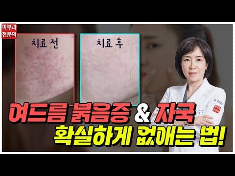 ⭐전격 공개⭐ 여드름 자국(색소침착) & 붉음증 확실하게 없애는 법