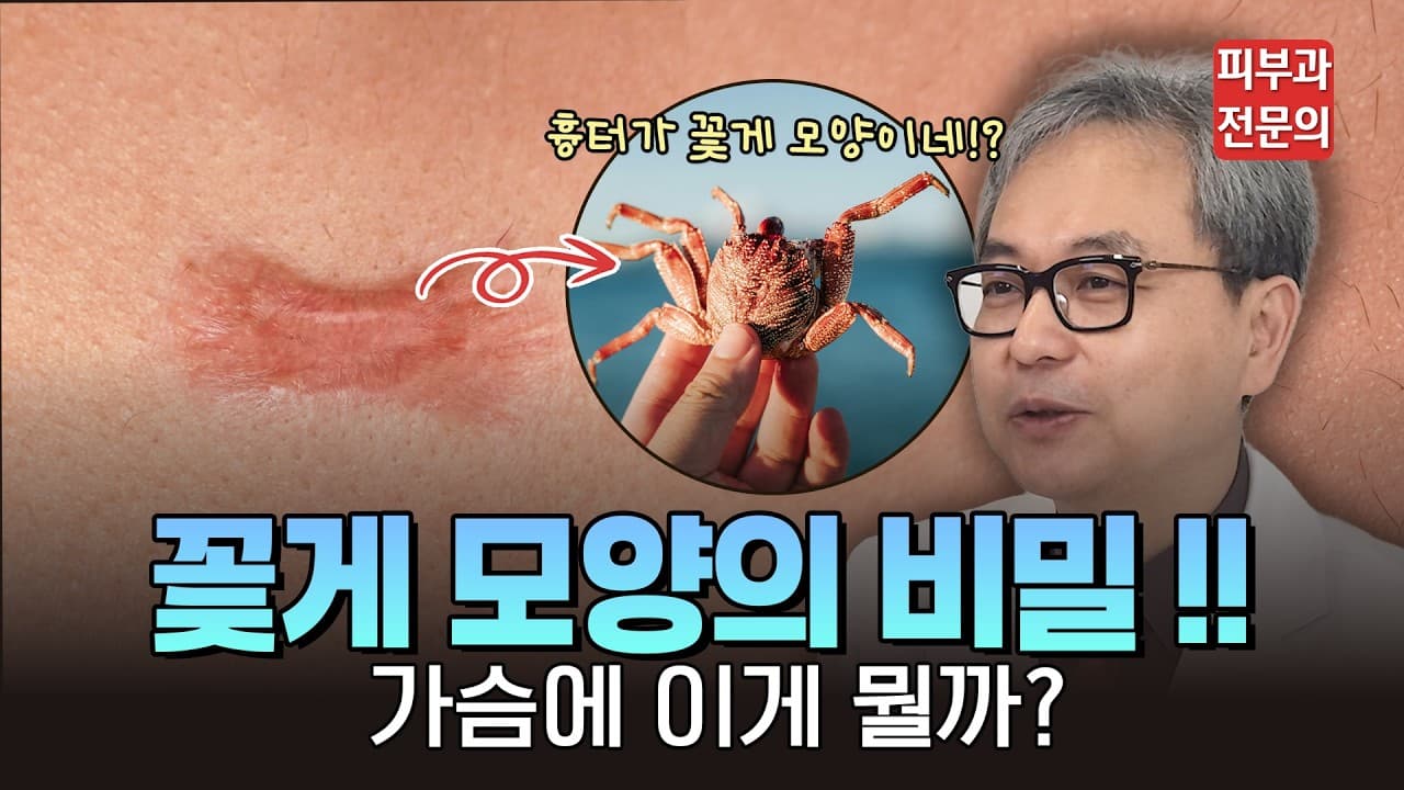 유독 가슴 켈로이드가 더 딱딱하고 아픈 이유 (feat. 여드름과 켈로이드가 같이 있다면?)