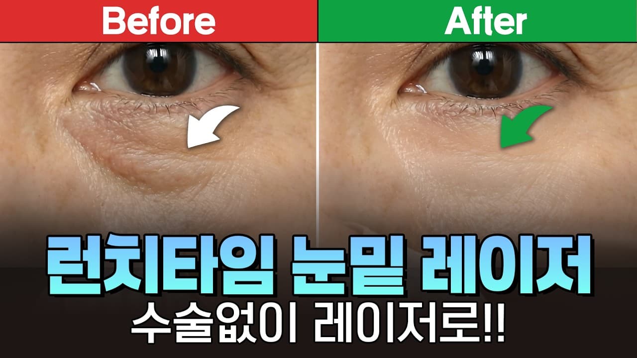 칼 대지 않는 눈밑 관리, 비절개 눈밑 레이저를 권하는 이유 | 신촌 연세스타피부과