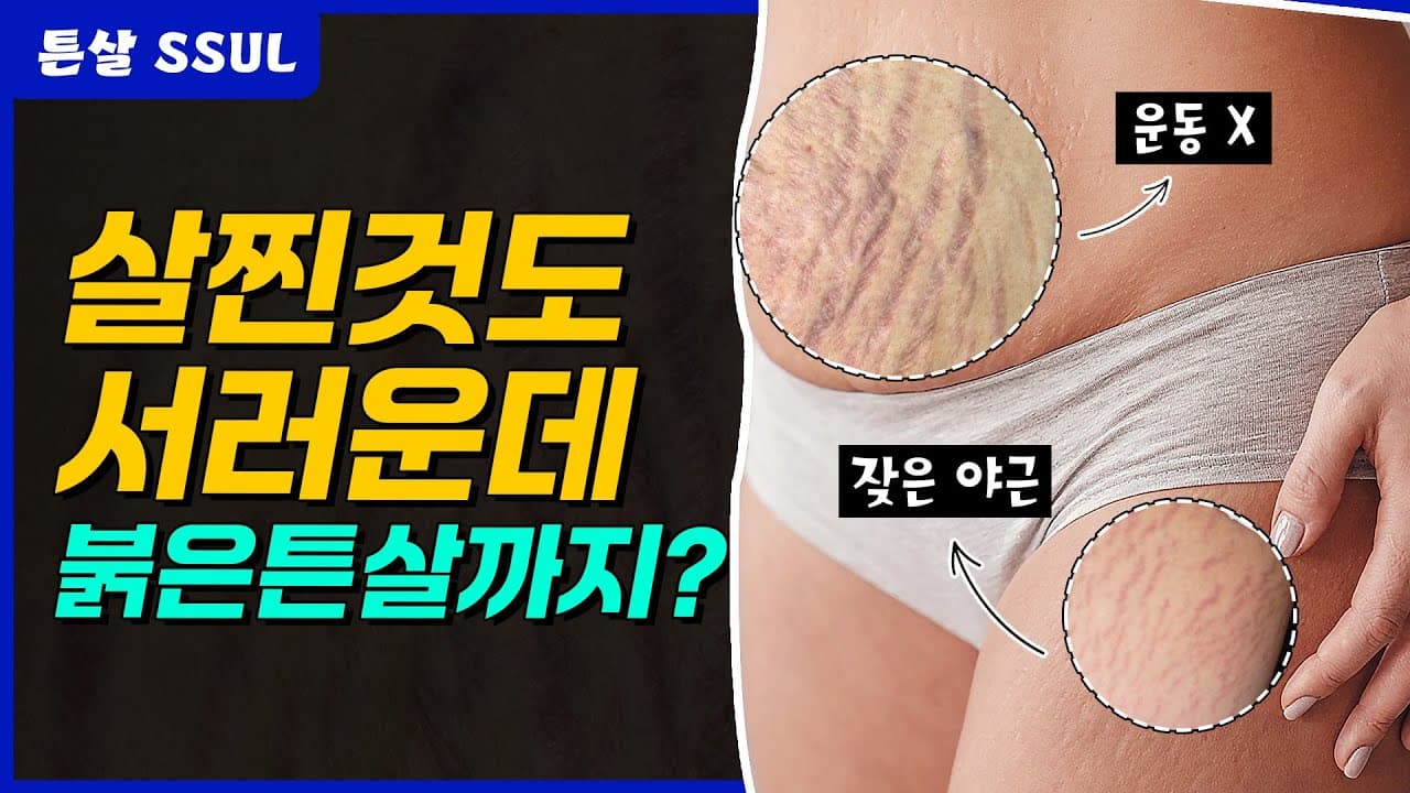 살찐 것도 서러운데… 붉은 튼살까지? 현실 직장인의 고백