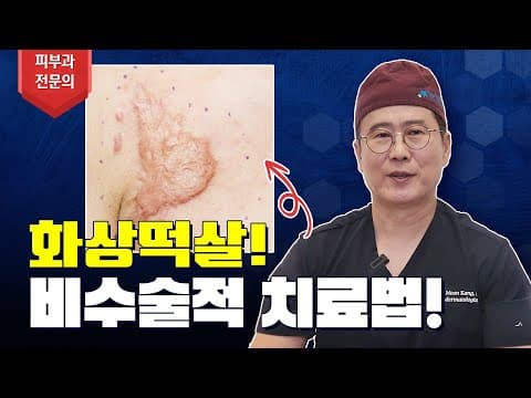 NO 수술🙅🏻‍♂️ 화상떡살 확실하게 치료하는 법 [feat. 화상흉터 명의피셜]