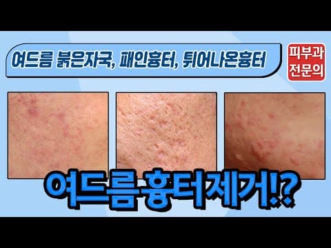 여드름흉터 확실한 치료방법이 알고 싶다면?