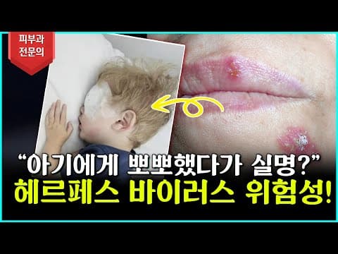 아기에게 뽀뽀했다가 실명?! 헤르페스 바이러스, 몰랐다간 큰일 납니다