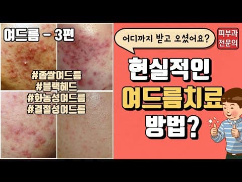 여드름 3부: 나에게 맞는 현실적인 여드름 치료는? (염증주사, 먹는 약)