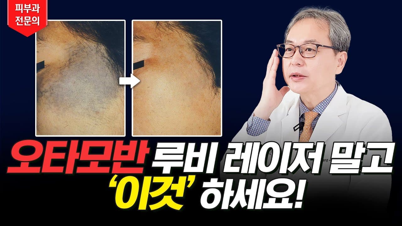 Nevus Of Ota Removal: A Laser Treatment More Effective Than Ruby Laser