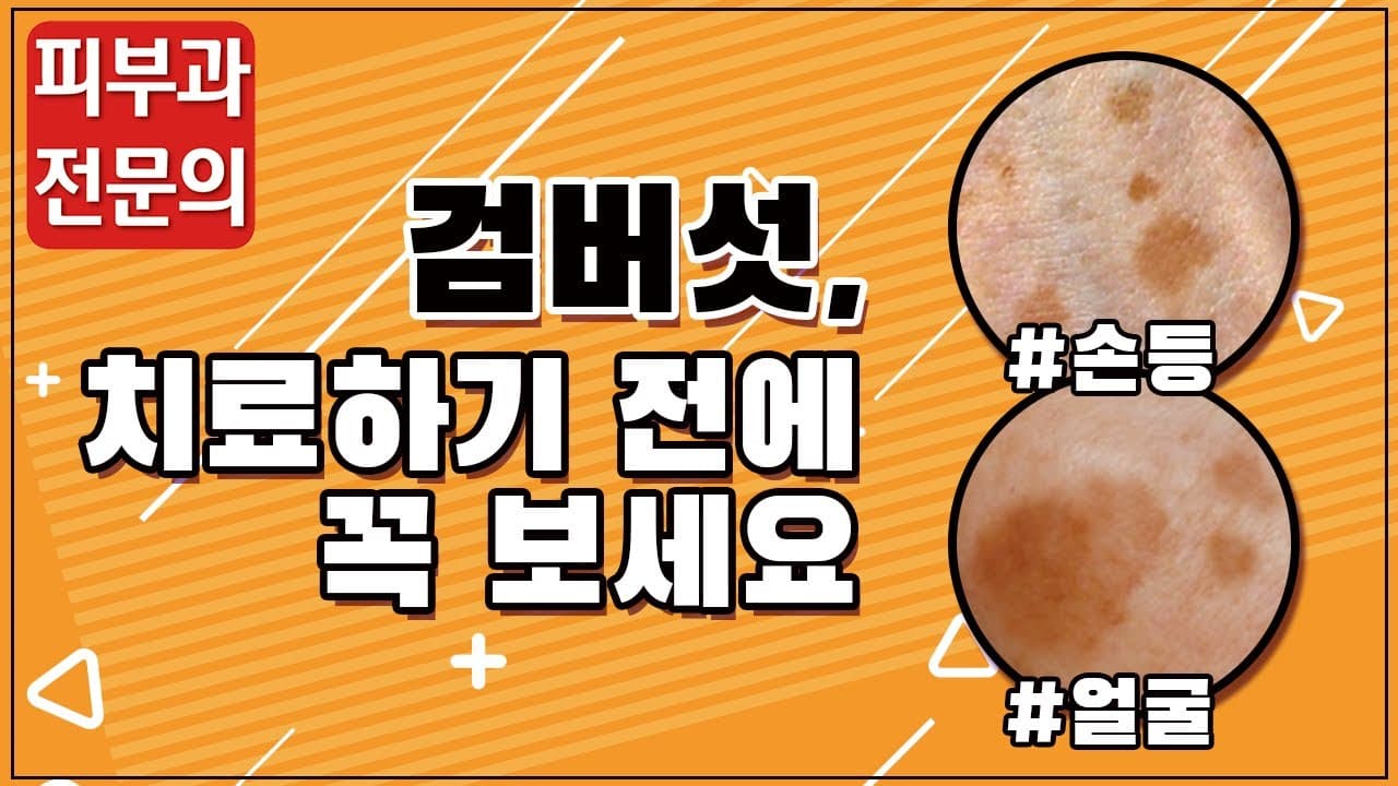 검버섯, 치료하기 전에 꼭 보세요(feat.피부암)