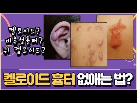 켈로이드흉터 없애는 방법?(켈로이드 원인, 예방, 치료법까지)