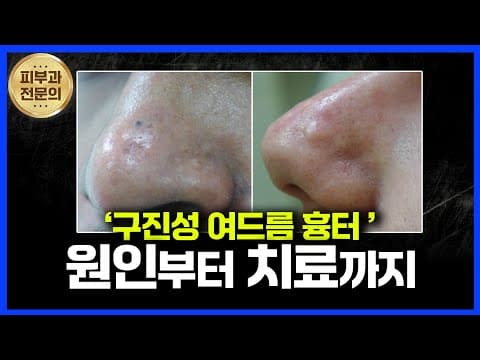 돌출된 흉터? 구진성 여드름 흉터 치료법 총정리!