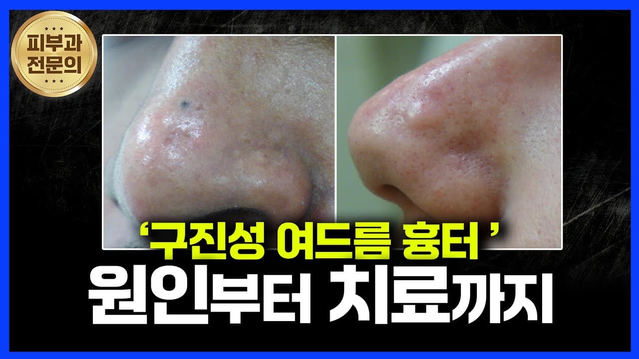 돌출된 흉터? 구진성 여드름 흉터 치료법 총정리!
