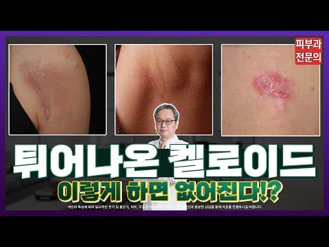 켈로이드흉터제거, 무엇이든 다 물어보세요! - 켈로이드주사, 켈로이드피부 [유튜브 라이브 하이라이트]