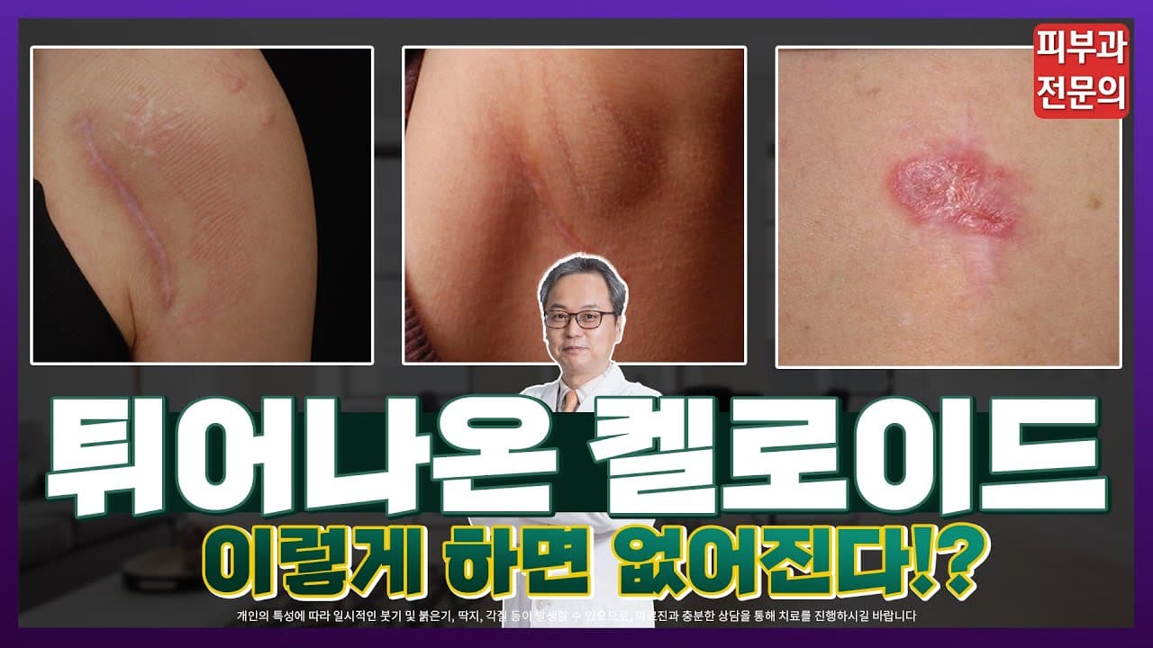 켈로이드흉터제거, 무엇이든 다 물어보세요! - 켈로이드주사, 켈로이드피부 [유튜브 라이브 하이라이트]