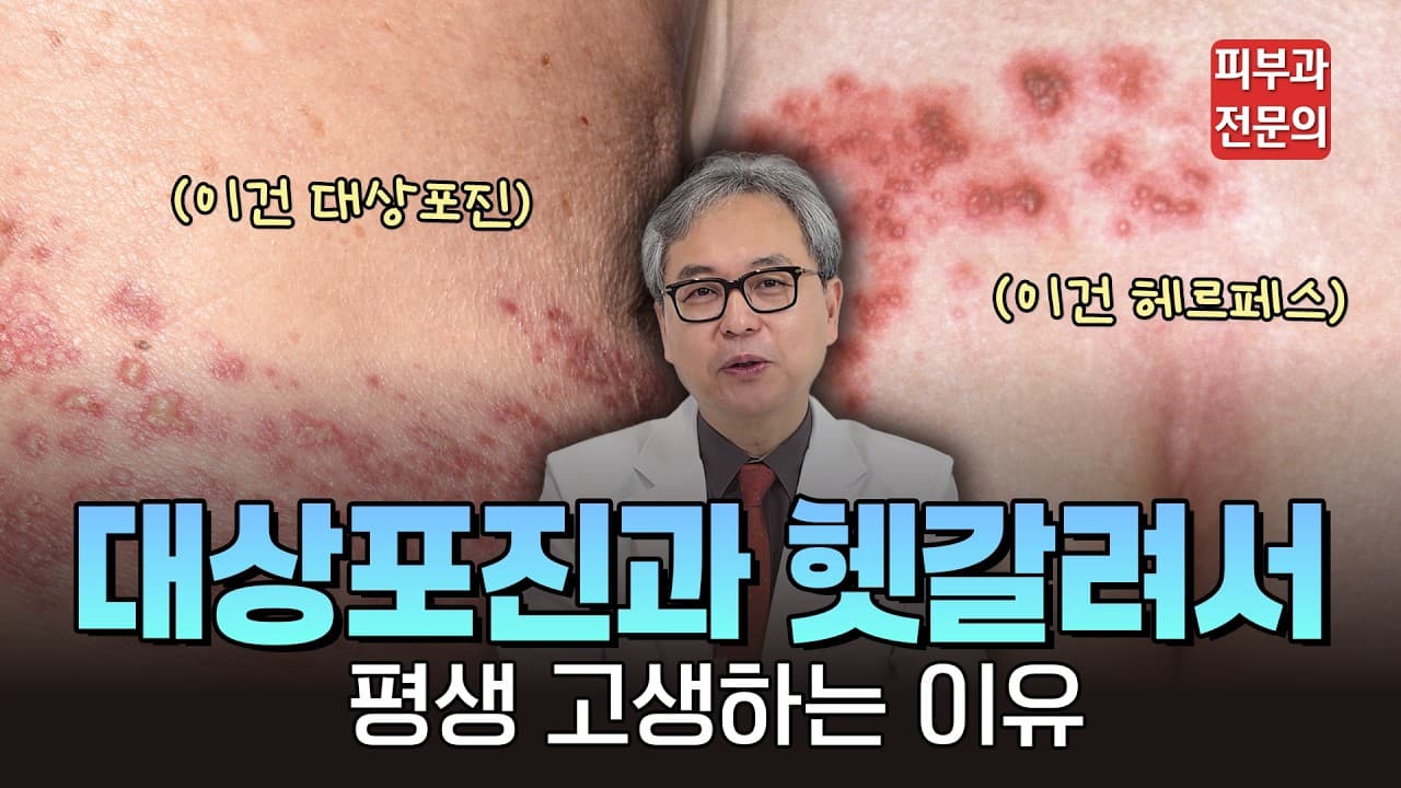 단순히 피곤해서 생긴 물집이 아니라고?" 피부과 전문의가 말하는 단순포진과 대상포진의 결정적 차이 #대상포진 #헤르페스 #단순포