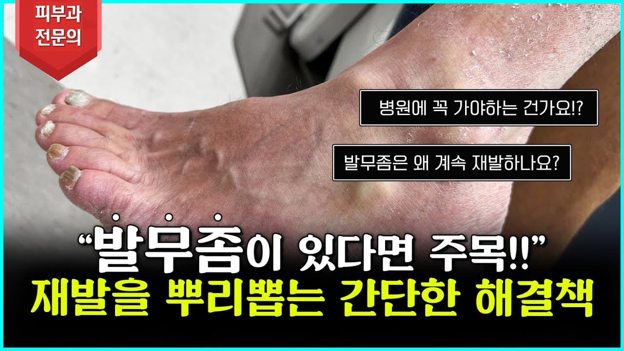 발무좀, 절대 이렇게 두면 안 됩니다! 지금까지고통받고 있는사람 모여라!
