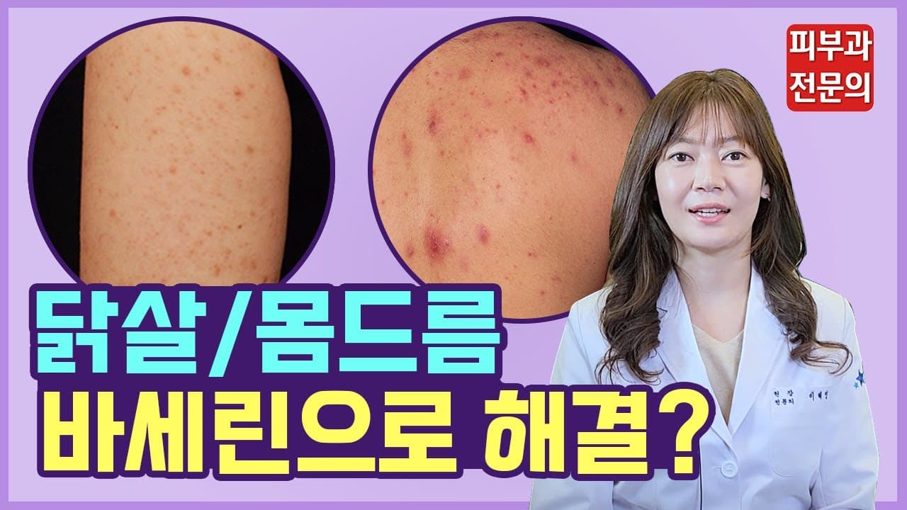 Bumpy Chicken Skin And Body Acne Keratosis Pilaris Back And Chest Acne Removal