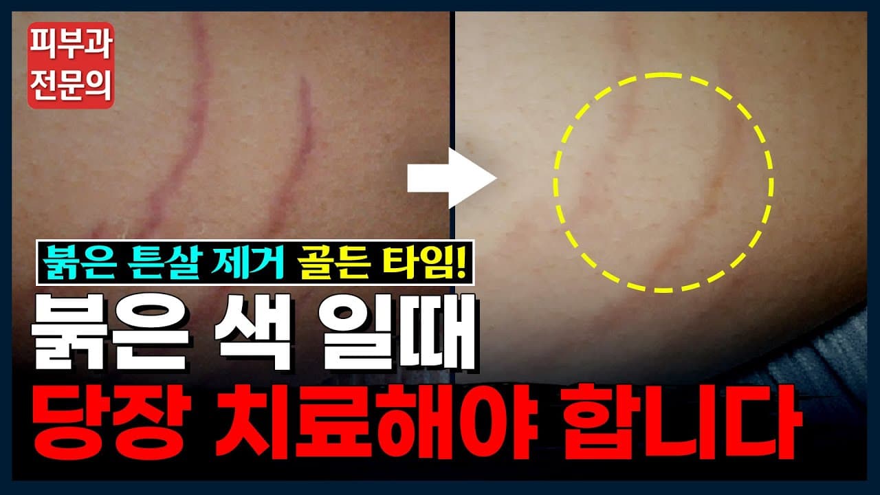 红色妊娠纹 现在就该治疗的理由 红色妊娠纹去除激光乳膏