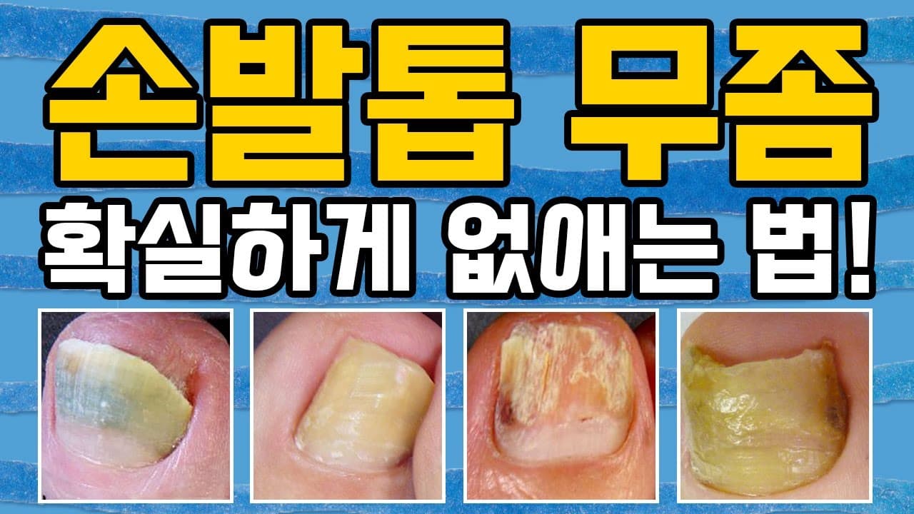 手指甲和脚趾甲灰指甲？想治好就进来
