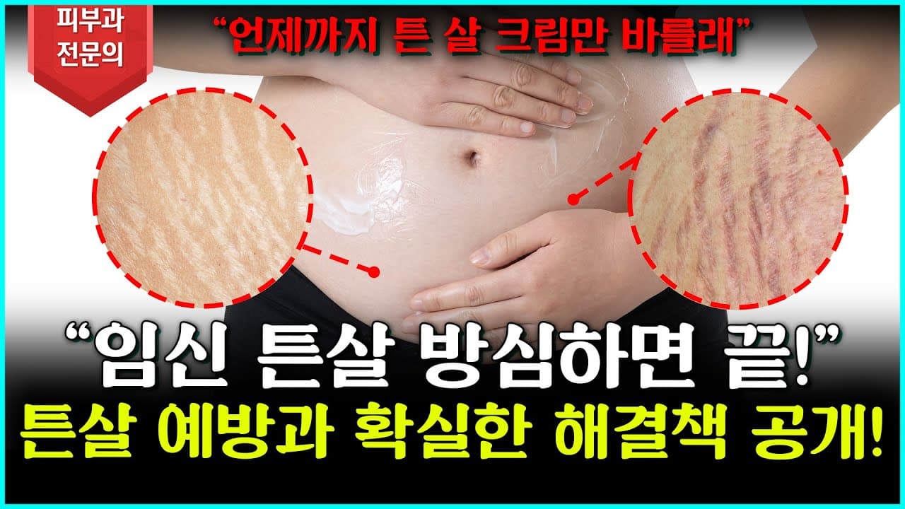 [임신 튼살] 이렇게 관리하면 달라집니다! 튼살 예방과 확실한 해결책 공개!