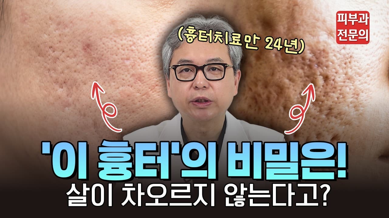 아무리 좋은 치료를 받아도 여드름 흉터가 그대로라면? 밑에서 당기는 '이것'부터 끊으세요