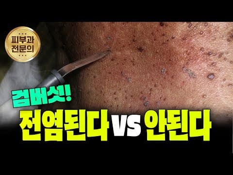 진짜로 전염된다!? 검버섯에 대한 궁금증 지금 모두 해결해 드립니다!