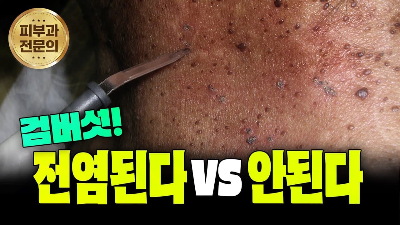 真的会传染？关于老年斑的疑问现在全部为您解答