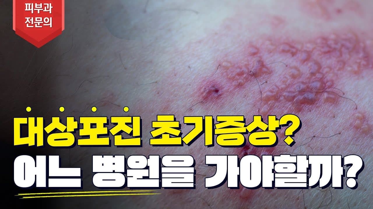 Shingles Symptoms Treatment Pain And Scar Care In Five Minutes
