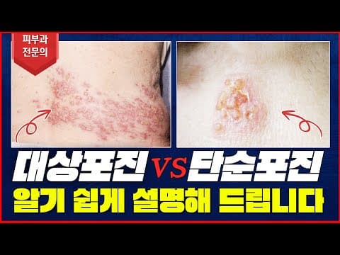 単純疱疹と帯状疱疹の違い 治療法 感染を解説 ヘルペス