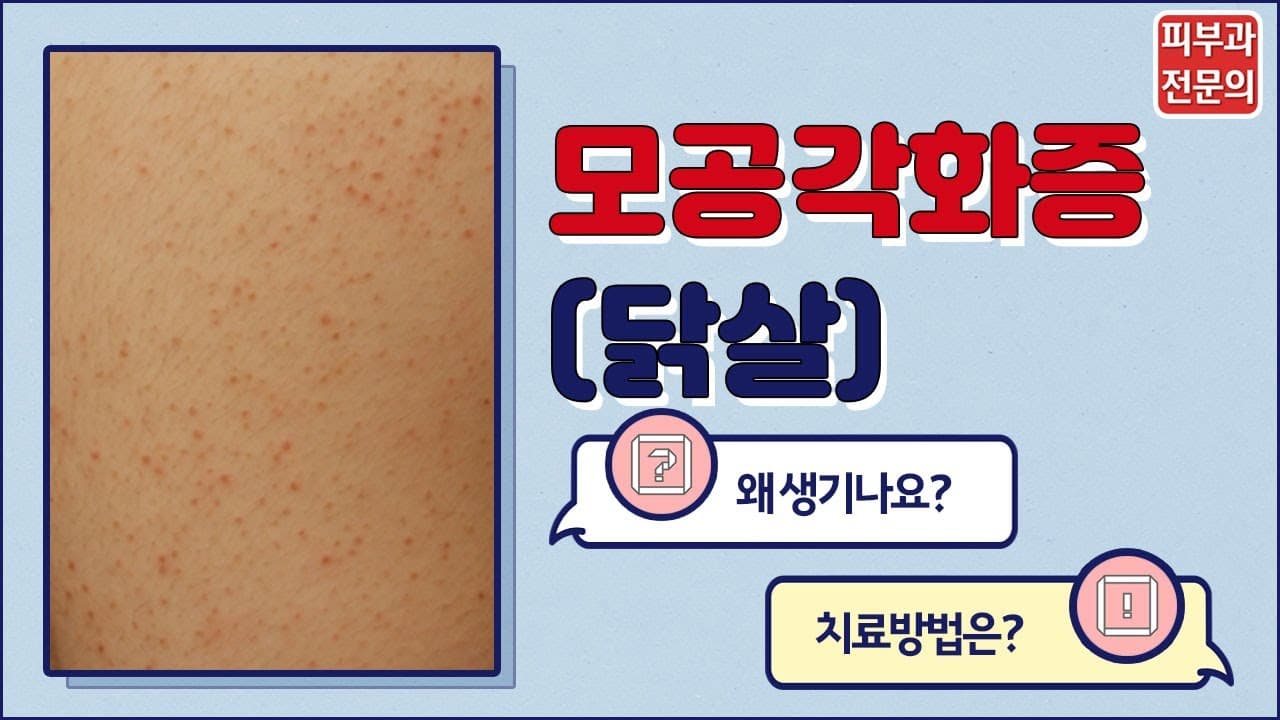 Keratosis Pilaris Chicken Skin For Those Worried About Bumpy Skin