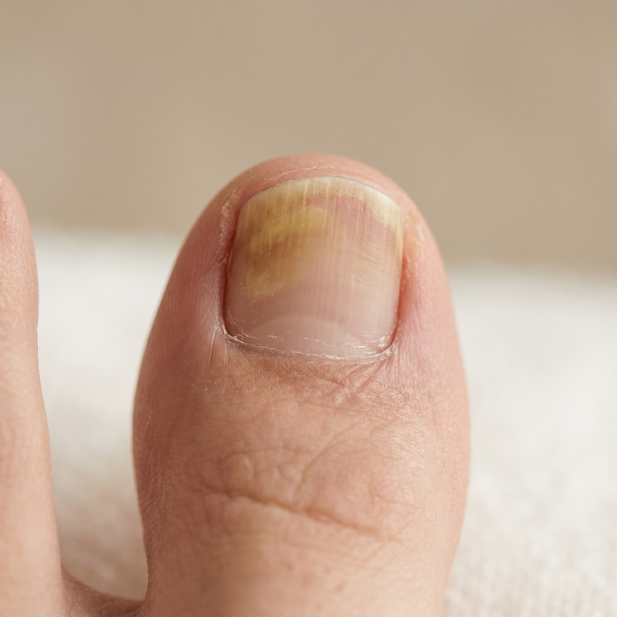 Yellowed Toenails